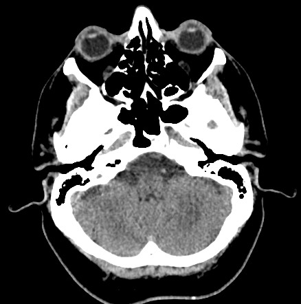 Acute internal carotid artery dissection (Radiopaedia 53541-59558 Axial non-contrast 12).jpg