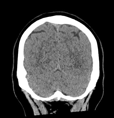 Acute internal carotid artery dissection (Radiopaedia 53541-59558 Coronal non-contrast 63).jpg