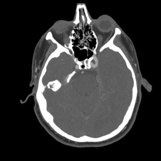 File:Acute internal carotid artery dissection (Radiopaedia 53541-59630 D 27).jpg