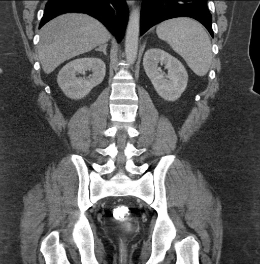 Acute mesenteric venous ischemia (Radiopaedia 46041-50383 Coronal C+ portal venous phase 66).jpg