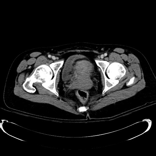 Acute myocardial infarction in CT (Radiopaedia 39947-42415 Axial C+ portal venous phase 129).jpg