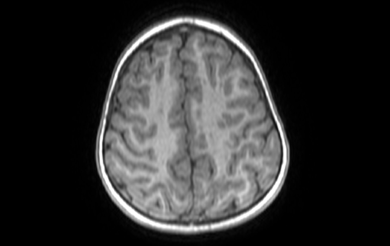File:Acute necrotizing encephalitis of childhood (Radiopaedia 67356-76737 Axial T1 21).jpg