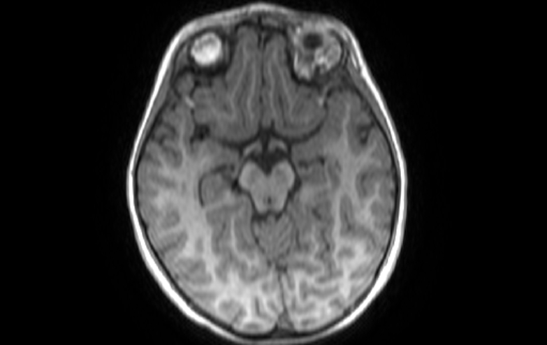 File:Acute necrotizing encephalitis of childhood (Radiopaedia 67356-76737 Axial T1 58).jpg
