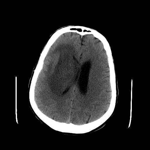 File:Acute necrotizing toxoplasma encephalitis (Radiopaedia 10683-11150 Axial non-contrast 13).jpg