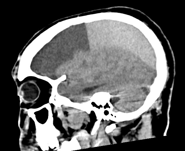 Acute on chronic subdural hematoma (Radiopaedia 78346-90966 Sagittal non-contrast 42).jpg