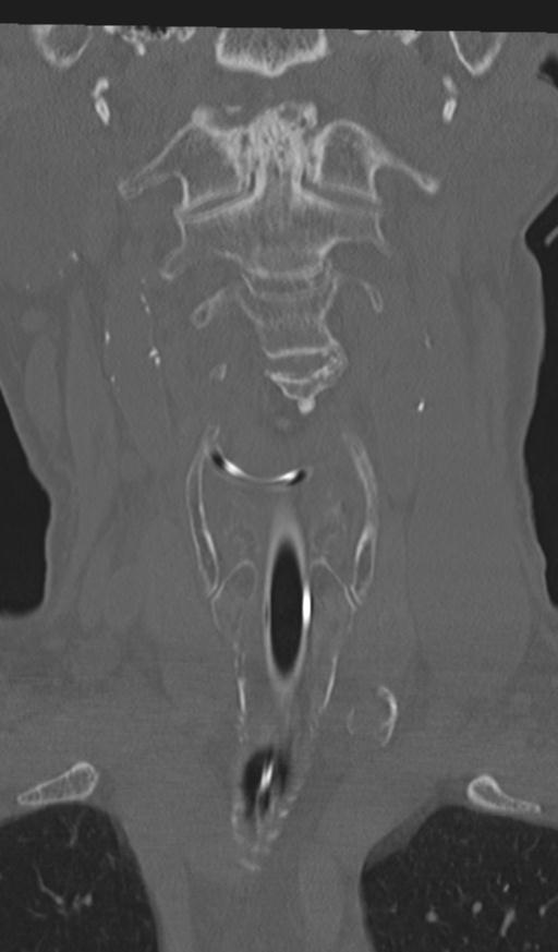 Acute on chronic subdural hematoma and thoracic vertebral injury in a multitrauma patient (Radiopaedia 31698-32619 Coronal bone window 12).jpg
