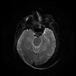Acute otitis externa (Radiopaedia 57296-64236 Axial DWI 32).jpg