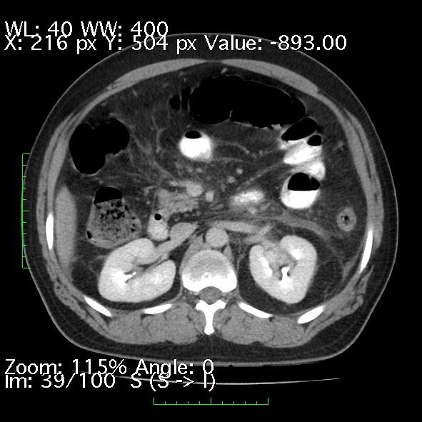 Acute pancreatitis (Radiopaedia 34043-35276 Axial C+ portal venous phase 39).jpg