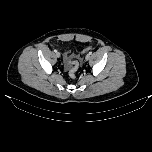 Acute pancreatitis (Radiopaedia 87428-103757 Axial C+ portal venous phase 84).jpg