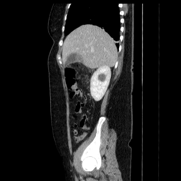 Acute pancreatitis - Balthazar C (Radiopaedia 26569-26714 Sagittal C+ portal venous phase 20).jpg