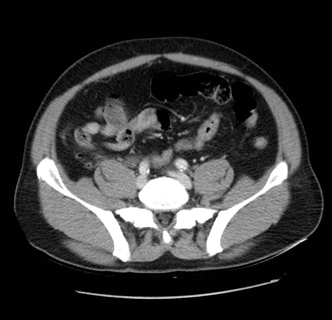 Acute pancreatitis - Balthazar E (Radiopaedia 23080-23110 Axial C+ portal venous phase 50).jpg