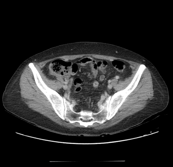 File:Acute pancreatitis - Balthazar E - post ERCP (Radiopaedia 27562-27772 Axial C+ portal venous phase 61).png