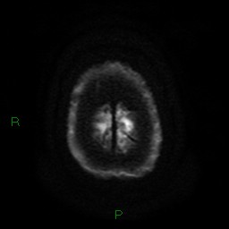 Acute posterior cerebral artery territory infarct (Radiopaedia 79329-92394 Axial DWI 27).jpg