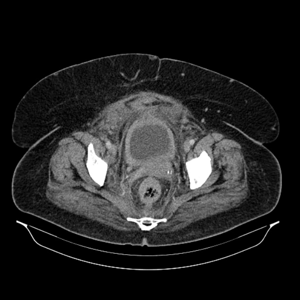 Acute pyelonephritis (Radiopaedia 25657-25837 Axial renal parenchymal phase 71).jpg
