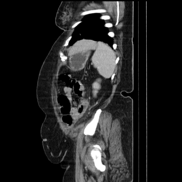 Acute pyelonephritis (Radiopaedia 25657-25837 Sagittal renal parenchymal phase 64).jpg