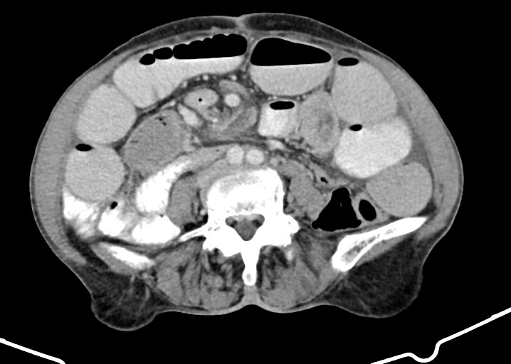 Acute small bowel (ileal) volvulus (Radiopaedia 71740-82139 Axial C+ portal venous phase 124).jpg