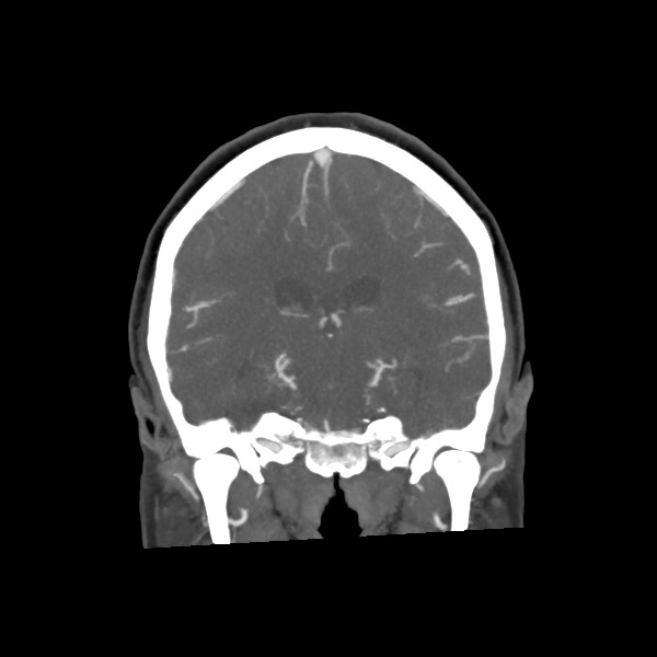File:Acute subarachnoid hemorrhage and accessory anterior cerebral artery (Radiopaedia 69231-79009 Coronal C+ arterial phase 47).jpg