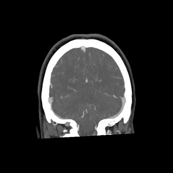 File:Acute subarachnoid hemorrhage and accessory anterior cerebral artery (Radiopaedia 69231-79009 Coronal C+ arterial phase 63).jpg
