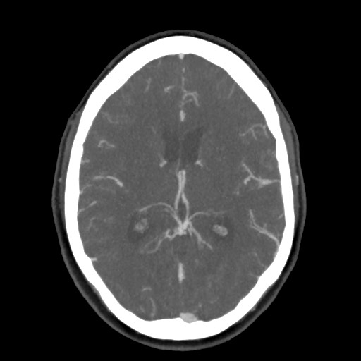 Acute subarachnoid hemorrhage and accessory anterior cerebral artery (Radiopaedia 69231-79009 D 39).jpg