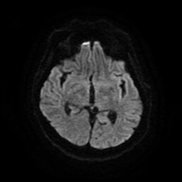 File:Acute superior cerebellar artery territory infarct (Radiopaedia 84104-99358 Axial DWI 51).jpg