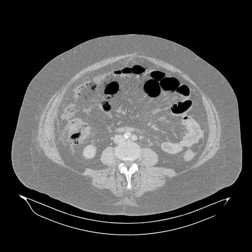 Acute superior mesenteric artery occlusion (Radiopaedia 51288-56960 Axial lung window 36).jpg