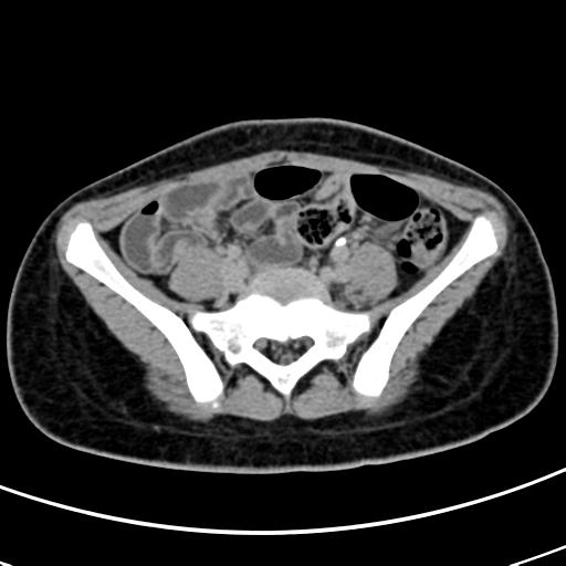 File:Acute suppurative pyelonephritis (Radiopaedia 18306-18147 Axial renal excretory phase 119).jpg