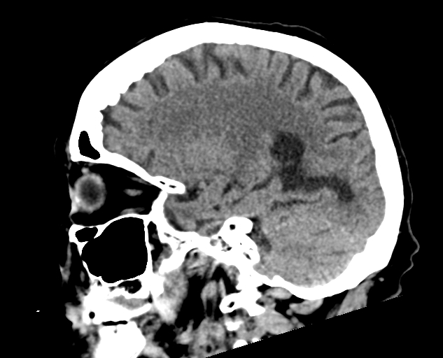 Acute traumatic subdural hematoma (Radiopaedia 82921-97257 Sagittal non-contrast 48).jpg