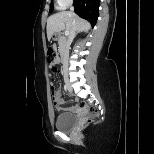 Acute uncomplicated appendicitis (Radiopaedia 73704-84499 Sagittal C+ portal venous phase 102).jpg