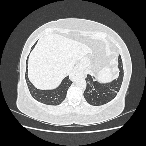 Adenocarcinoma in situ of lung (Radiopaedia 38685-40829 B 189).png