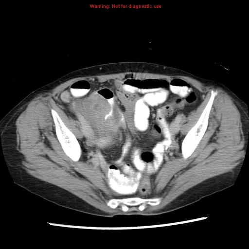 Adenocarcinoma of the colon (Radiopaedia 8191-9039 Axial renal excretory phase 49).jpg