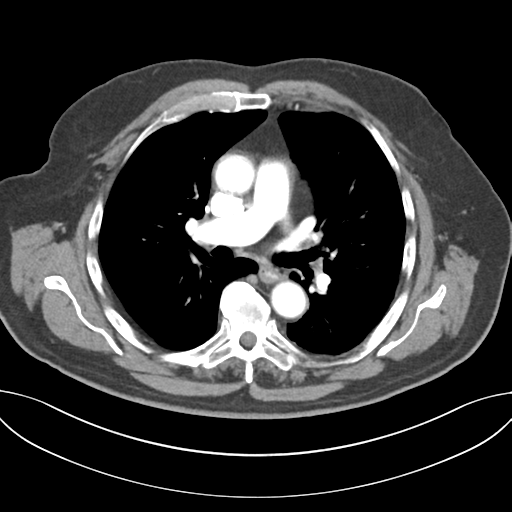 Adenocarcioma of rectum- T1 lesion (Radiopaedia 36921-38547 Axial C+ arterial phase 27).png