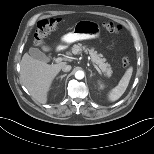 Adenocarcioma of rectum- T1 lesion (Radiopaedia 36921-38547 Axial C+ arterial phase 57).png