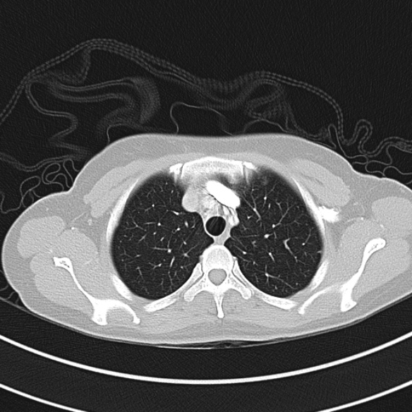 Adenocystic carcinoma of the trachea (Radiopaedia 47677-52525 Axial lung window 37).jpg
