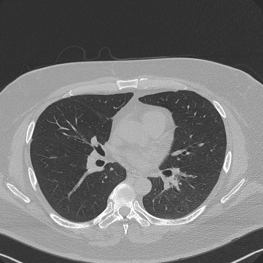 Adenoid cystic carcinoma of the trachea (Radiopaedia 49042-54137 Axial lung window 182).jpg