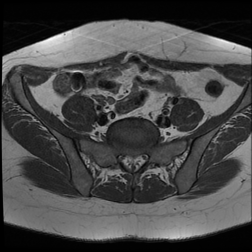 File:Adenomyosis-scar endometriosis (Radiopaedia 65863-75022 Axial T1 5).jpg