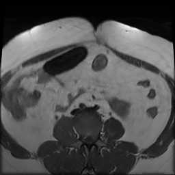 File:Adenomyosis within a didelphys uterus (Radiopaedia 70175-80215 Axial T1 5).jpg