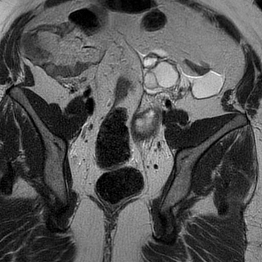 File:Adenomyosis within a didelphys uterus (Radiopaedia 70175-80215 Coronal T2 23).jpg