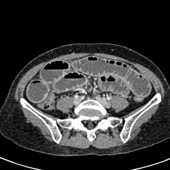 Adhesional small bowel obstruction (Radiopaedia 48397-53305 Axial C+ portal venous phase 61).jpg