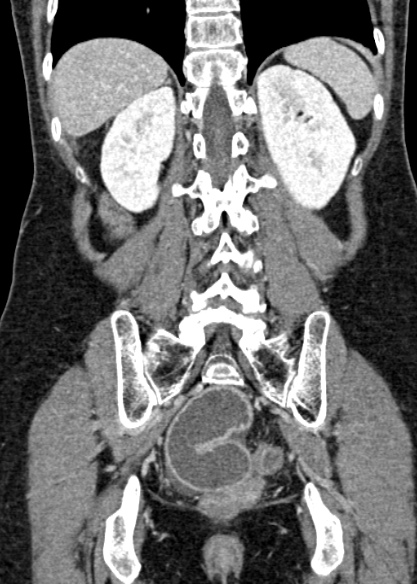 Adhesional small bowel obstruction (Radiopaedia 48397-53305 Coronal C+ portal venous phase 265).jpg