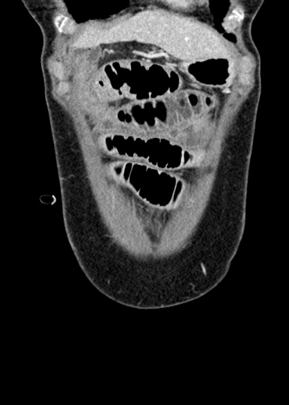 Adhesional small bowel obstruction (Radiopaedia 48397-53305 Coronal C+ portal venous phase 52).jpg