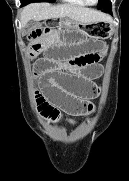 Adhesional small bowel obstruction (Radiopaedia 48397-53305 Coronal C+ portal venous phase 77).jpg