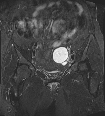 File:Adnexal multilocular cyst (O-RADS US 3- O-RADS MRI 3) (Radiopaedia 87426-103754 Coronal T2 fat sat 13).jpg