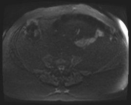Adrenal cortical carcinoma (Radiopaedia 64017-72770 Axial DWI 129).jpg