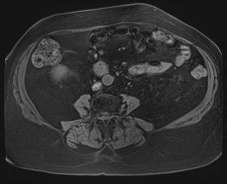 Adrenal cortical carcinoma (Radiopaedia 64017-72770 Axial T1 fat sat 63).jpg