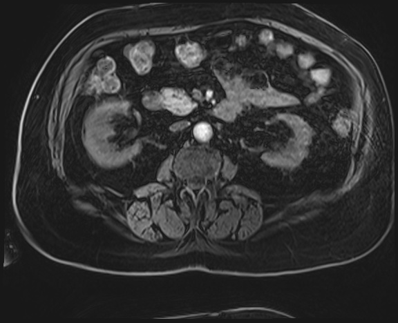 Adrenal cortical carcinoma (Radiopaedia 64017-72770 H 27).jpg
