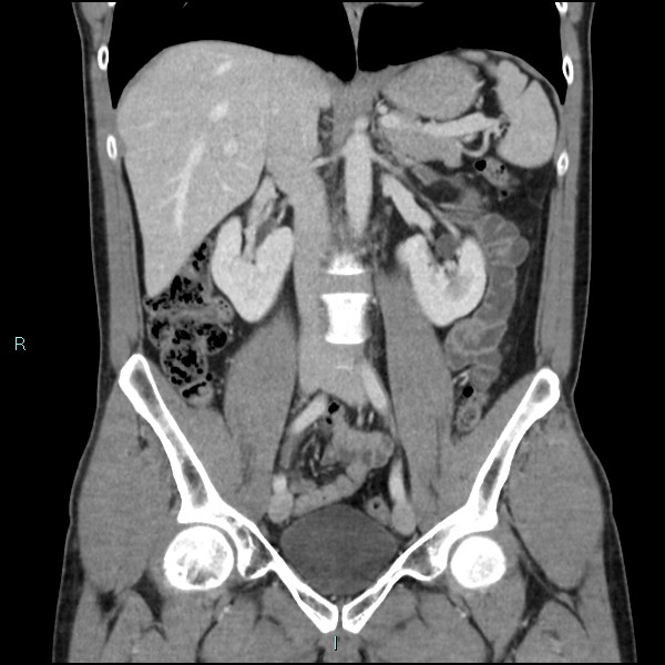 Adrenal cystic lymphangioma (Radiopaedia 83161-97534 Coronal C+ portal venous phase 38).jpg