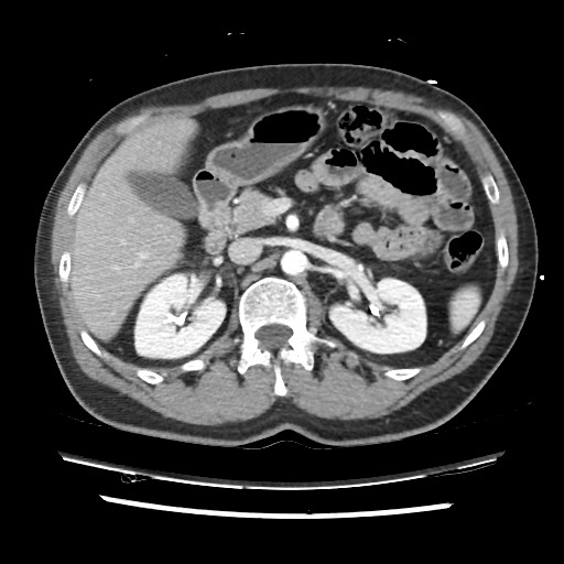 File:Adrenal gland trauma (Radiopaedia 81351-95078 Axial Dual bolus trauma C+ 69).jpg