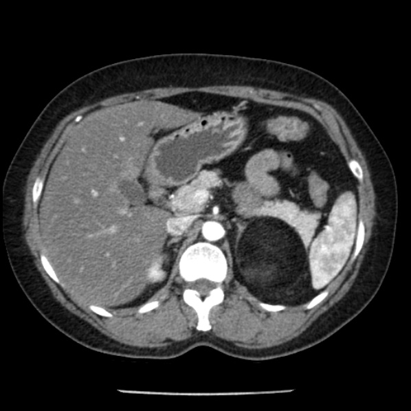Adrenal myelolipoma (Radiopaedia 43401-46759 Axial C+ arterial phase 31).jpg