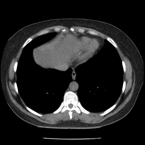 Adrenal myelolipoma (Radiopaedia 43401-46759 Axial non-contrast 6).jpg