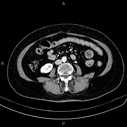 Adrenal myelolipoma (Radiopaedia 82742-96986 Axial renal cortical phase 100).jpg